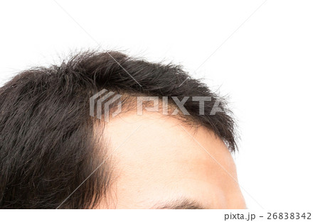 Young man serious hair loss problem 26838342