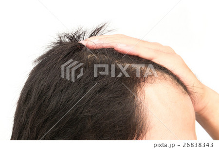 Young man serious hair loss problem 26838343