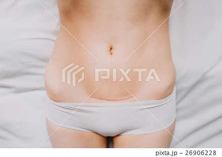 Closeup of woman belly with a scar from  26906228
