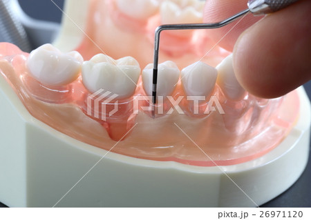 歯周病検診(軽度) 歯周病検診(軽度) 26971120