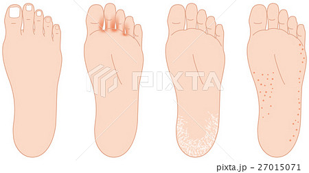 足の裏の悩み　水虫など 27015071