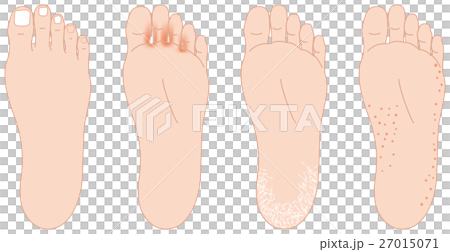 足の裏の悩み　水虫など 27015071