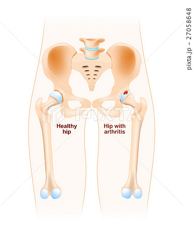 Hip joint with osteoarthritis 27058648