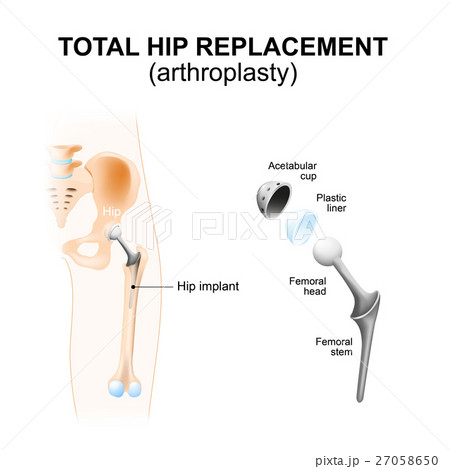 Total hip replacement or arthroplasty. 27058650