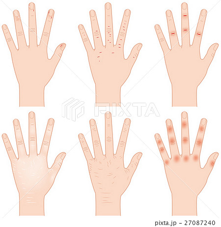 手荒れ　 27087240