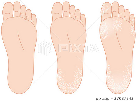 足の裏の角質のイラスト素材