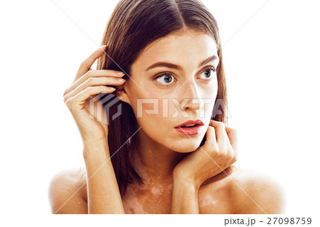 beautiful young brunette woman with vitiligo beautiful young brunette woman with vitiligo 27098759
