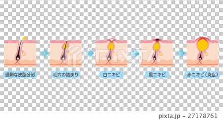 Progressive pore cross section of acne Progressive pore cross section of acne 27178761