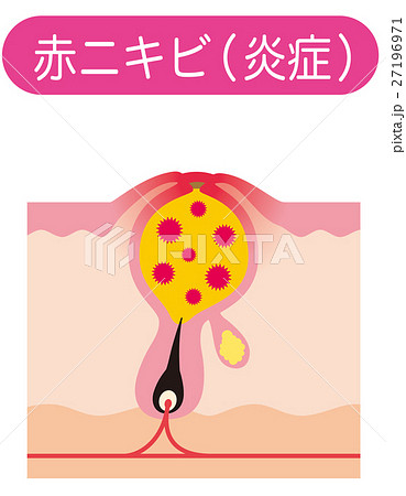 赤ニキビ　ニキビの仕組み　毛穴の構造 27196971