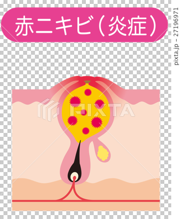赤ニキビ　ニキビの仕組み　毛穴の構造 27196971