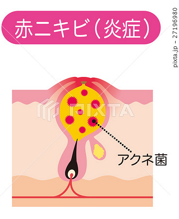 赤ニキビ　ニキビの仕組み　毛穴の構造 27196980