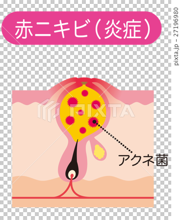 赤ニキビ　ニキビの仕組み　毛穴の構造 27196980