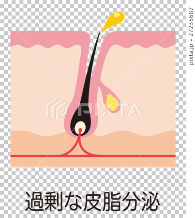 痤瘡的結構皮脂毛孔的結構 痤瘡的結構皮脂毛孔的結構 27235687