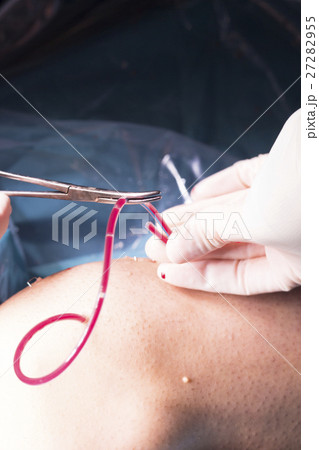 Surgical operation knee surgery 27282955