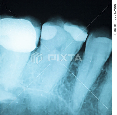 Tooth filling dental xray Tooth filling dental xray 27282960