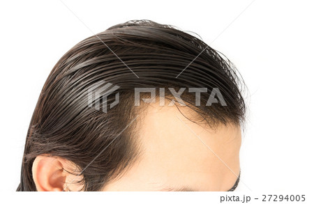 Closeup young man serious hair loss problem 27294005