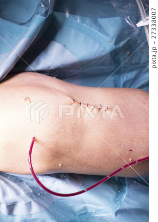 Surgical operation knee surgery 27338007