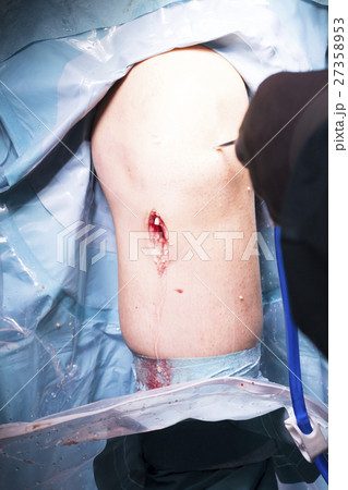 Surgical operation knee surgery 27358953