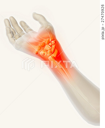 Wrist painful - skeleton x-ray. 27470926