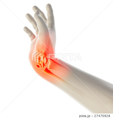 Wrist painful - skeleton x-ray. 27470928
