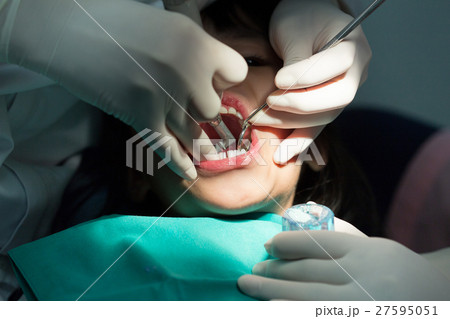 Dental treatment  children patient mouth  27595051