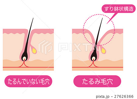 毛穴の断面 開いた毛穴 毛穴の断面 開いた毛穴 27626366