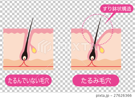毛穴の断面 開いた毛穴 毛穴の断面 開いた毛穴 27626366