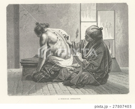 お灸：アンベール「幕末日本図絵」 1874のイラスト素材 [27807403] - PIXTA