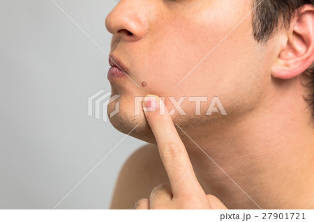 ニキビが気になる男性 27901721