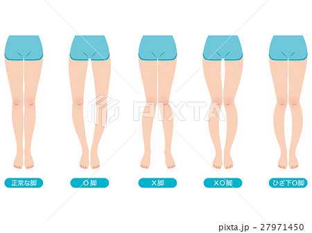 O脚矯正 骨盤のゆがみのイラスト素材