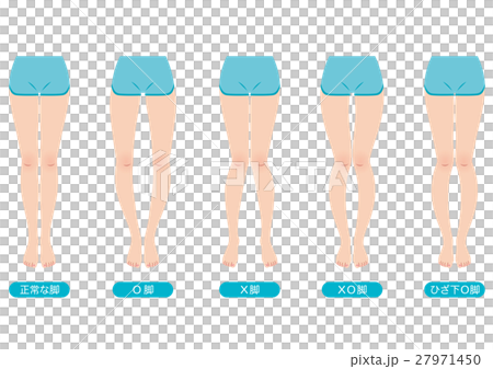 Distortion of O leg legal pelvis - Stock Illustration [27971450] - PIXTA