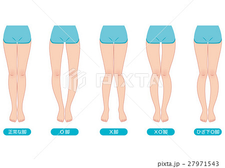 O脚矯正 骨盤のゆがみのイラスト素材
