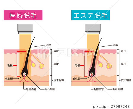医療脱毛　エステ脱毛 27997248