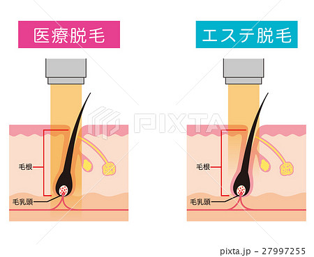 医療脱毛 エステ脱毛のイラスト素材