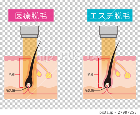 医療脱毛 エステ脱毛のイラスト素材