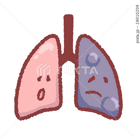 腫瘍ができた肺のイラスト素材