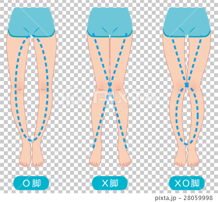 O脚矯正　骨盤のゆがみ 28059998