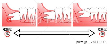 親知らず 埋伏智歯のイラスト素材