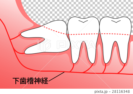 親知らず 埋伏智歯 親知らず 埋伏智歯 28116348