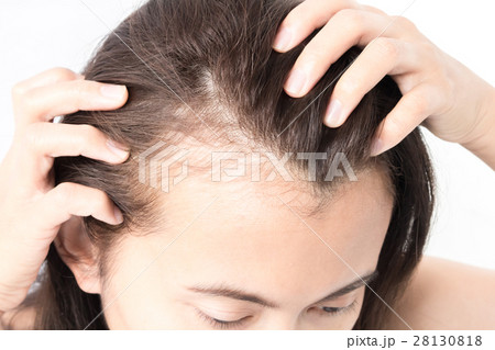 Woman serious hair loss problem 28130818
