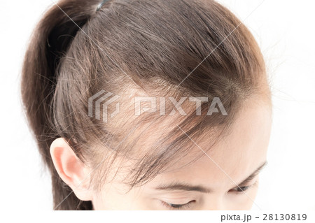 Woman serious hair loss problem 28130819