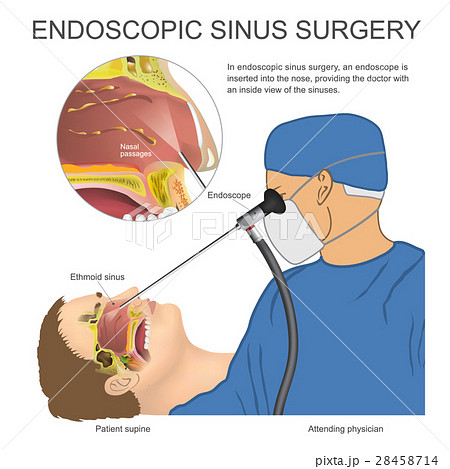 Endoscopic sinus surgery. - Stock Illustration [28458714] - PIXTA