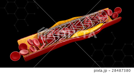 Stent implant concept as a heart disease treatment Stent implant concept as a heart disease treatment 28487380