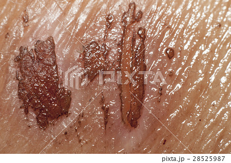 Soft Wounds on the skin Soft Wounds on the skin 28525987