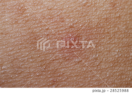 Soft Wounds on the skin Soft Wounds on the skin 28525988