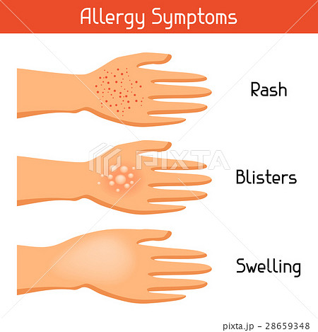 Allergy symptoms. Vector illustration for medical Allergy symptoms. Vector illustration for medical 28659348