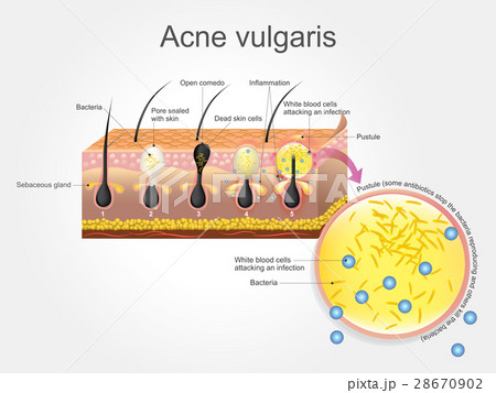 Acne Vulgaris 28670902