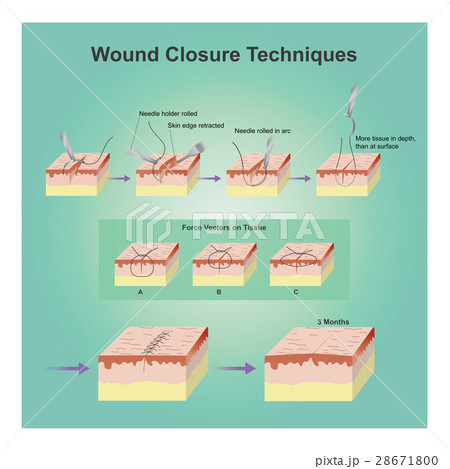 wound closure techniques 28671800