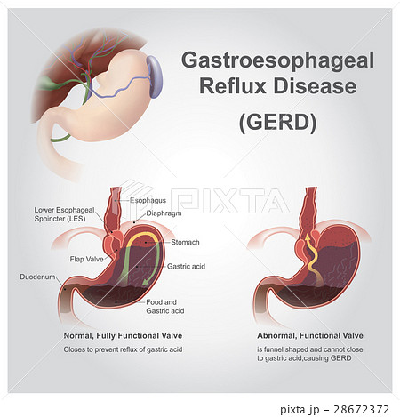 gastro reflux gastro reflux 28672372