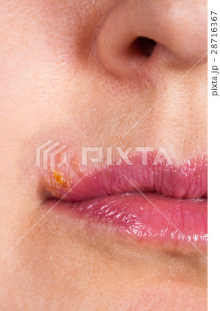 Herpes on the lip close up macro 28716367